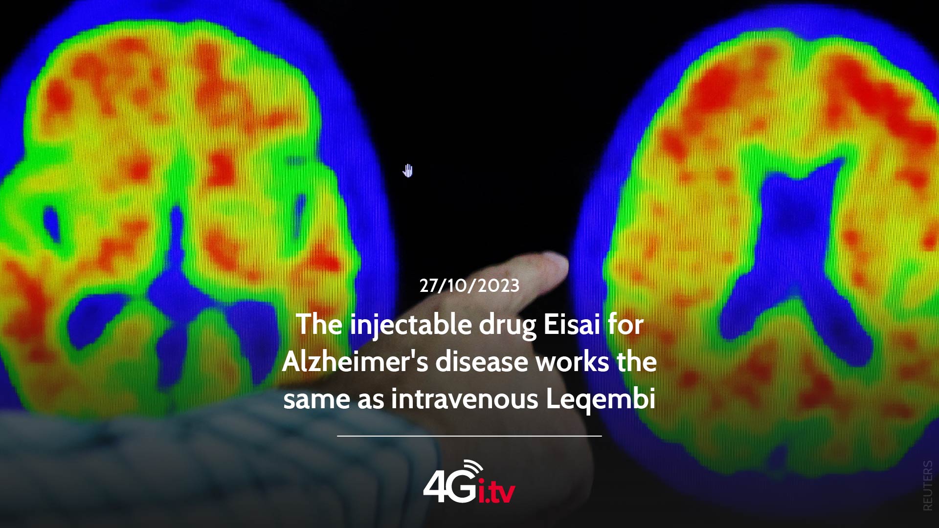 Read more about the article The injectable drug Eisai for Alzheimer’s disease works the same as intravenous Leqembi