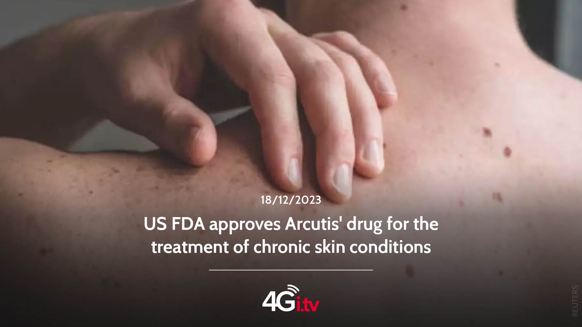 Подробнее о статье US FDA approves Arcutis’ drug for the treatment of chronic skin conditions