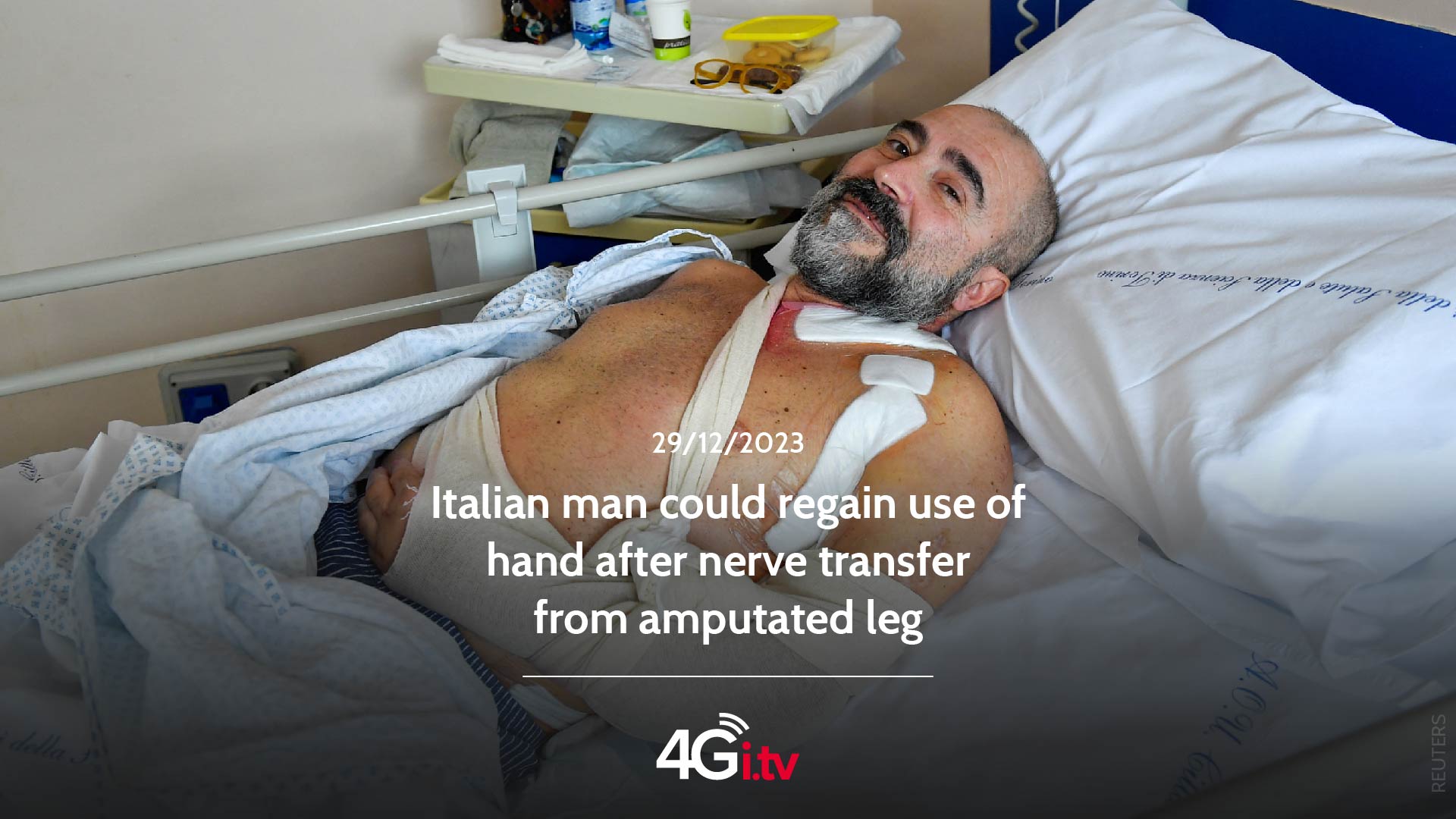 Подробнее о статье Italian man could regain use of hand after nerve transfer from amputated leg