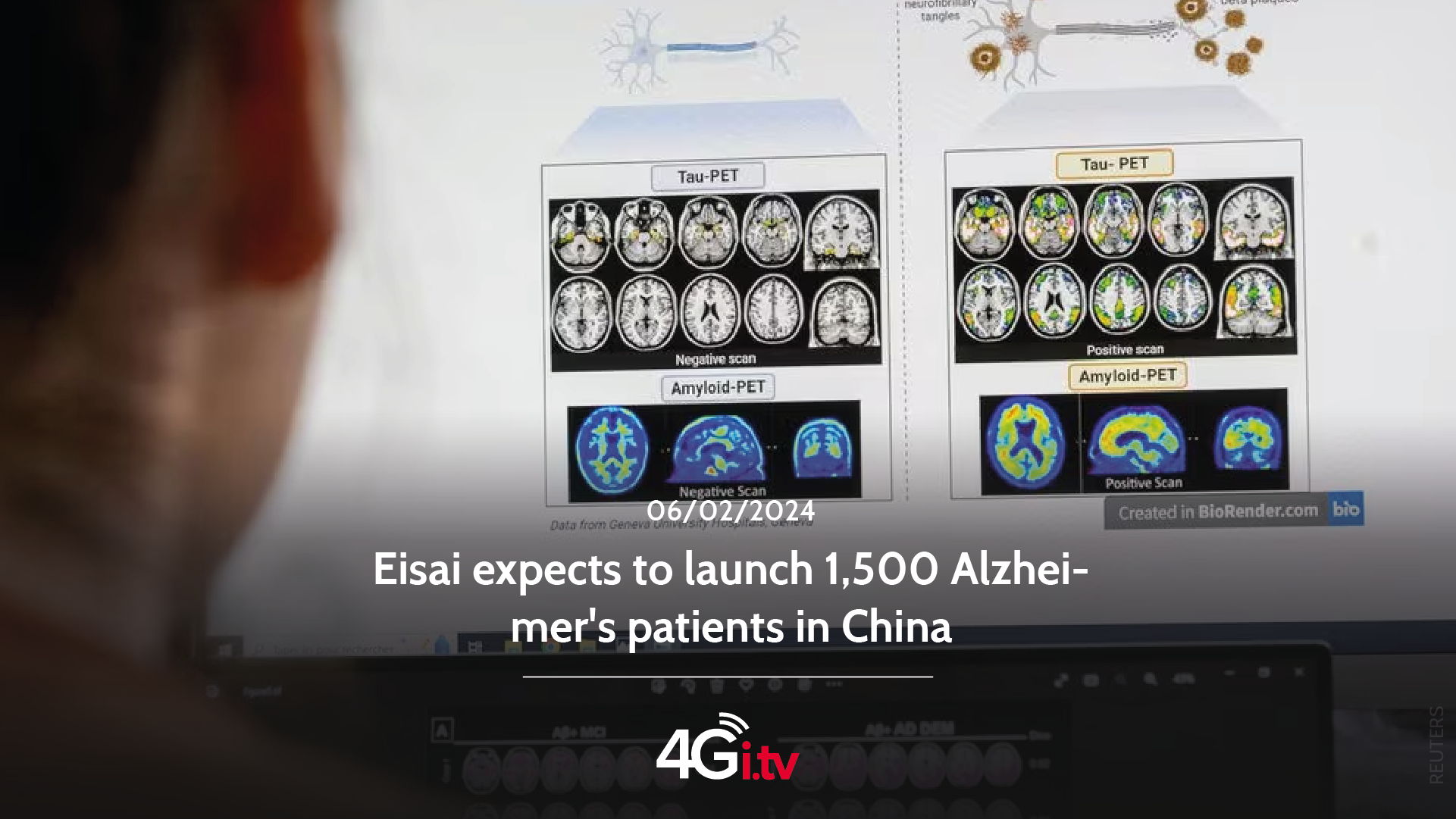 Read more about the article Eisai expects to launch 1,500 Alzheimer’s patients in China