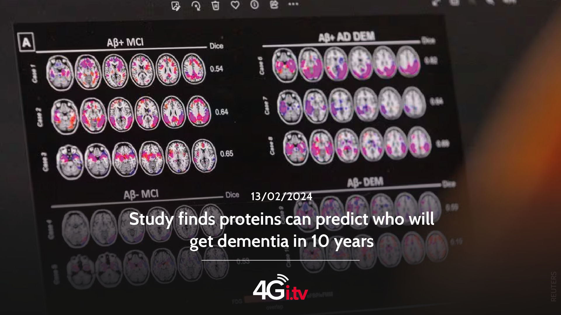 Read more about the article Study finds proteins can predict who will get dementia in 10 years 