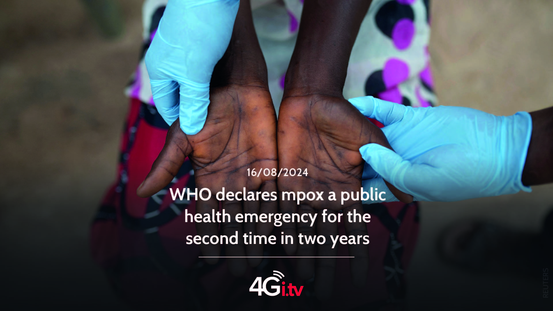 Lesen Sie mehr über den Artikel WHO declares mpox a public health emergency for the second time in two years