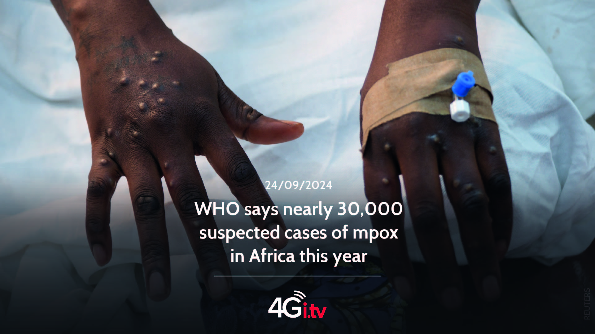 Read more about the article WHO says nearly 30,000 suspected cases of mpox in Africa this year